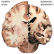 Illustration for article titled Alzheimers and Down Syndrome have link you can see in the eyes